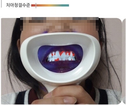 치아 세균 체크 기기