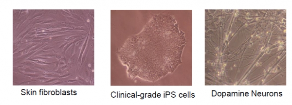 피부세포, 유도만능 줄기세포, 도파민 뉴런