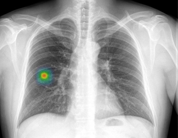 루닛에서 개발한 AI 판독 시스템 '인사이트 CXR' 흉부 판독영상