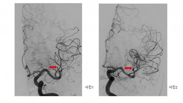 응급 뇌혈관 조영술상 중대 뇌동맥 분지부의 폐색(사진1. 화살표)이 관찰돼 뇌혈관 중재시술(흡입 혈전제거술)을 통해 1시간 이내에 완벽하게 혈전을 제거(사진2. 화살표)한 모습.