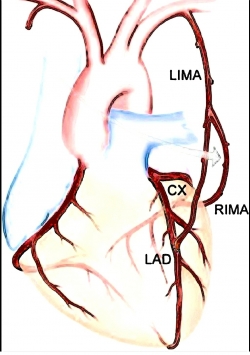 관상동맥우회술 모식도