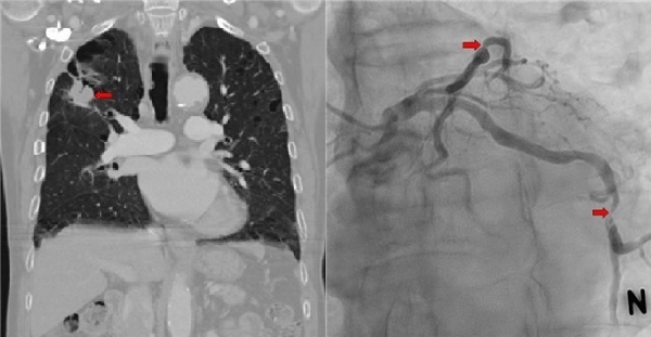 왼쪽/ 우상엽 폐암의 CT소견 (화살표), 오른쪽/ 관상 동맥 협착 (화살표)