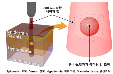 다중층으로 구성된 유방조직에서의 금나노입자를 이용한 광열 유방암치료 모식도
