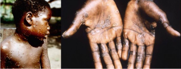 원숭이 두창/출처: WHO