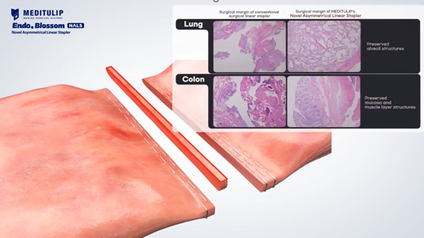 강민웅 교수가 개발한 메디튤립 NALS 자동 절제 봉합기