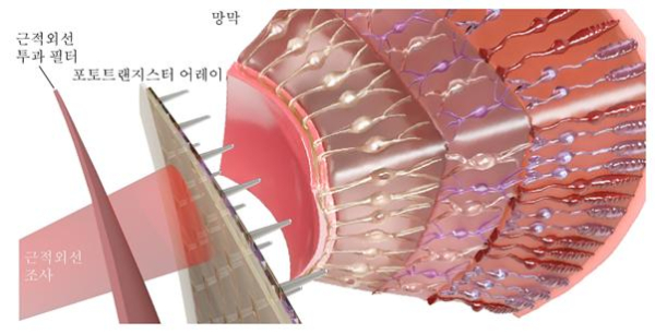 근적외선 감지 인공망막의 구조 및 이식 개념도
