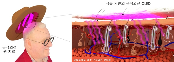 직물 기반 근적외선 OLED 모자를 이용한 광 치료 모식도